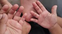 Bintik merah pada tangan dan kaki seorang balita, salah satu gejala dari penyakit Flu Singapura atau HFMD yang rentan terjadi pada anak di musim pancaroba. (Foto: Benedikta Desideria/Liputan6.com)