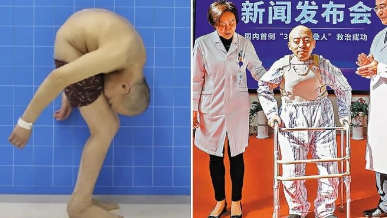 28 Tahun Hidup Membungkuk, Pria Ini Akhirnya Bisa Berdiri Tegak Kembali