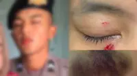 Viral Pengakuan Perempuan Dianiaya Pacar Polisi Sampai Dirawat 2 Minggu di Rumah Sakit
