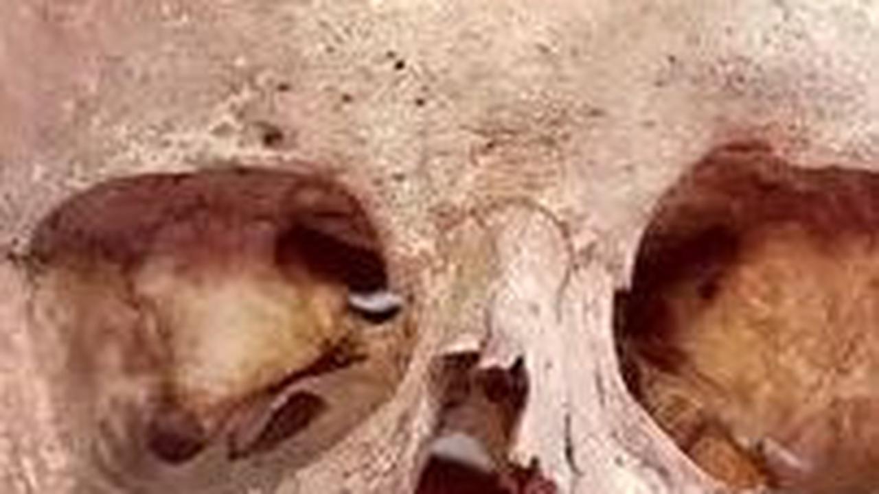 Salah satu tengkorak Zaman Perunggu memiliki lubang di tengkorak melalui metode trepanasi; individu ini tampaknya menderita beberapa penyakit, dan ini mungkin merupakan upaya penyembuhan.