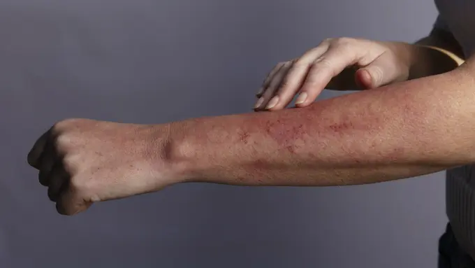 Ini Gejala Awal Penyakit Lupus yang Harus Diwaspadai