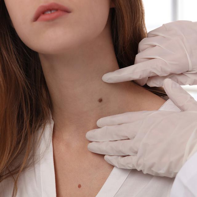 Hilangkan Tahi Lalat Dengan 5 Bahan Alami Ini On Off Liputan6 Com