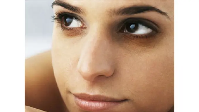 Apa Penyebab Lingkaran Hitam di Bawah Mata?