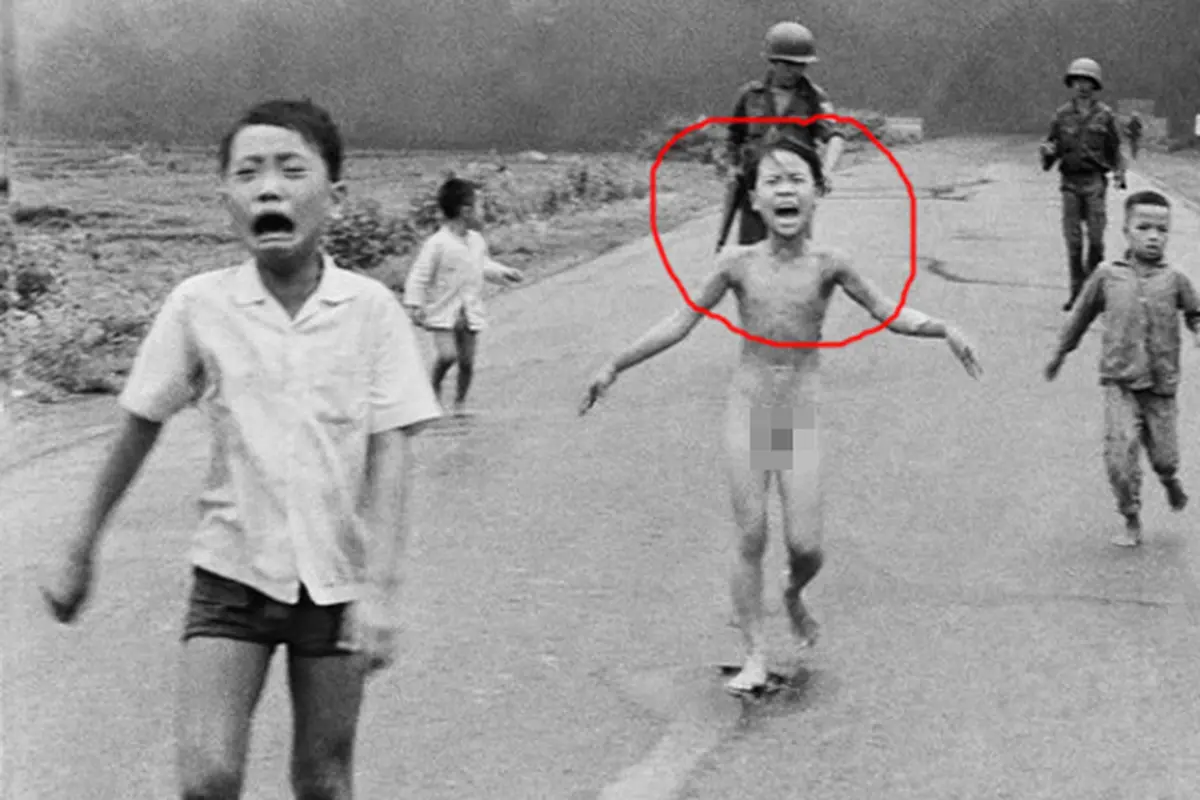 Kini Bocah Korban Bom dalam Foto Ikonik Jalani Penyembuhan