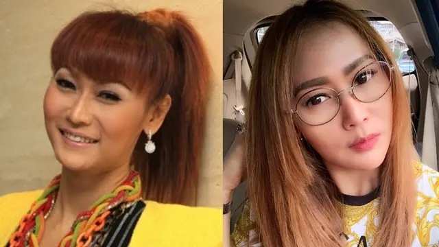 Potret Penyanyi Cantik Sebelum dan Sesudah Tanam Benang