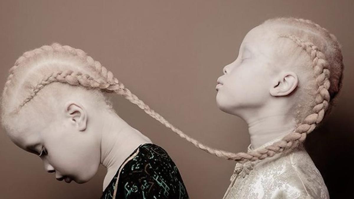 Pesona Model Kembar dengan Kondisi Albino: Cantik Banget! - Photo ...