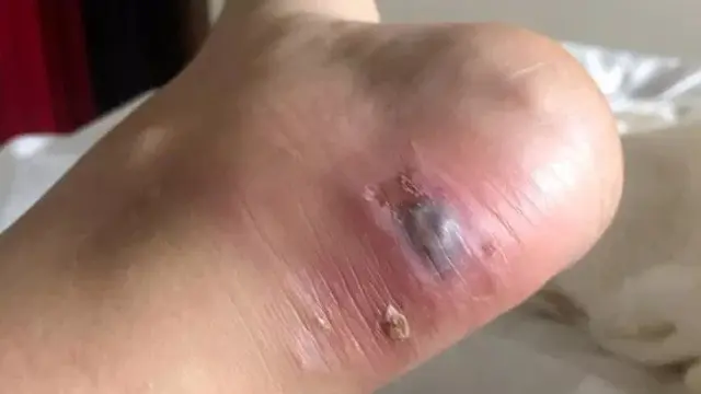 hampir meninggal karena heels