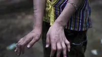 Remaja perempuan ini diduga disiksa hingga kedua jari tangannya memiliki luka bakar dan bengkok (AFP)
