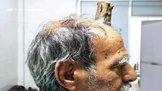 Ada tanduk tumbuh di kepala pria India ini