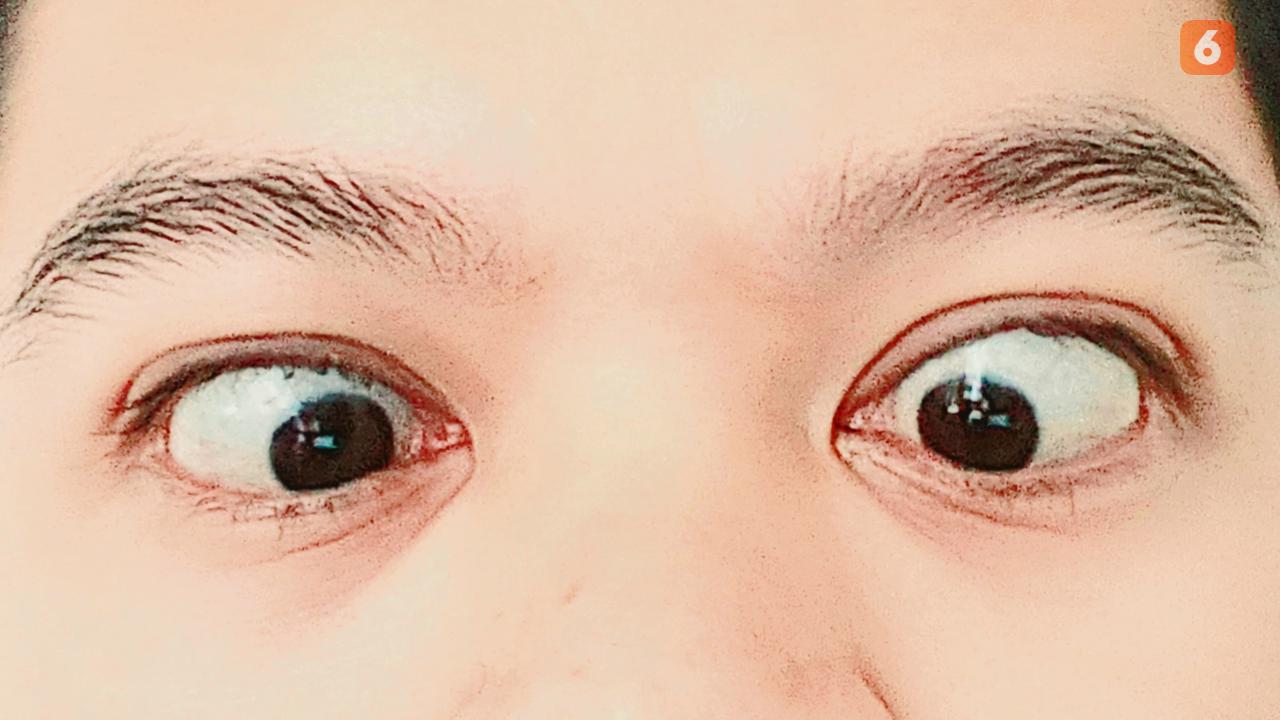 Mata Juling Bukan Sekadar Masalah Estetika, Bisa Pengaruhi Kemampuan Penglihatan Jika Tak Ditangani