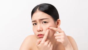 Ilustrasi Kulit Berjerawat Credit: pexels.com/Laluna