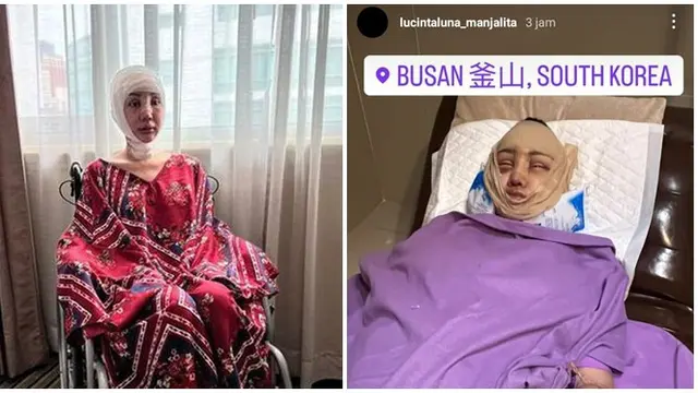 8 Potret Lucinta Luna Kembali Jalani Operasi Plastik, Curi Perhatian