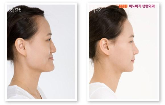 Perubahan bentuk wajah yang biasa dilakukan oleh wanita Korea | Photo copyright en.rocketnews24.com