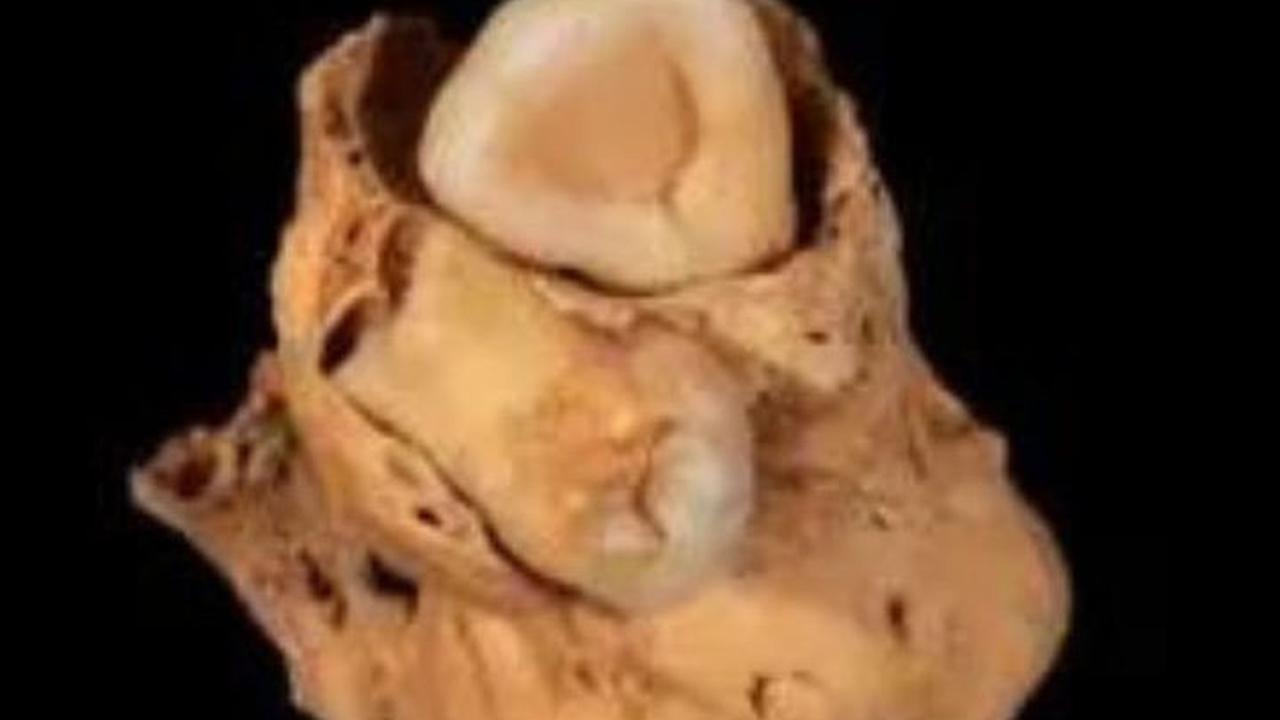 Arkeolog Temukan Kerangka Wanita Mesir Kuno Penderita Tumor Langka Bawa Jimat Penyembuh