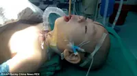 Sumpit Bersarang di Otak Balita Usia 18 Bulan