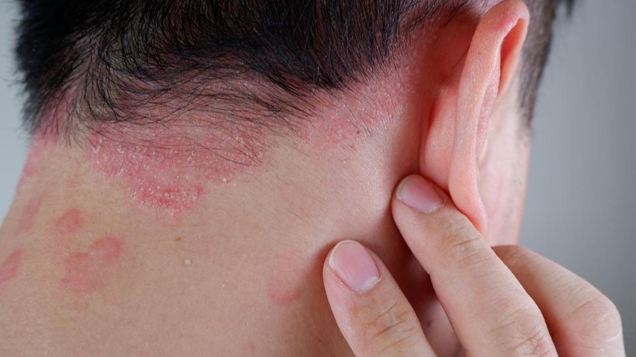 <b>6. Psoriasis </b>