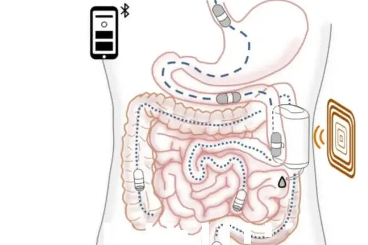Robot kecil untuk menyuntikkan insulin di dalam perut pasien diabetes. Dok: Sant’Anna School of Advanced Studies