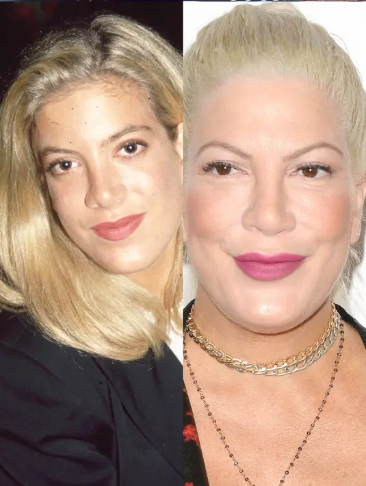 Tori Spelling mengatakan pada People bahwa ia mengoperasi hidungnya. (REX/Shutterstock/HollywoodLife)