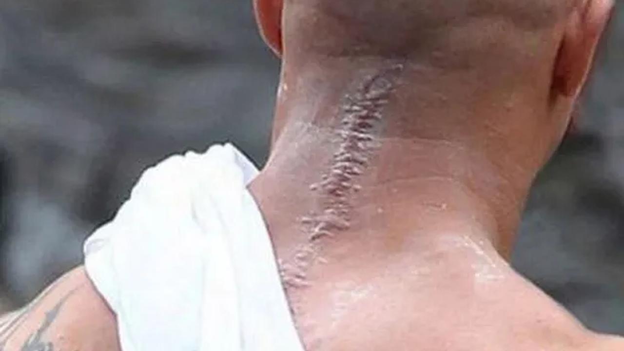 Luka parut yang ada di punggung leher Bane.