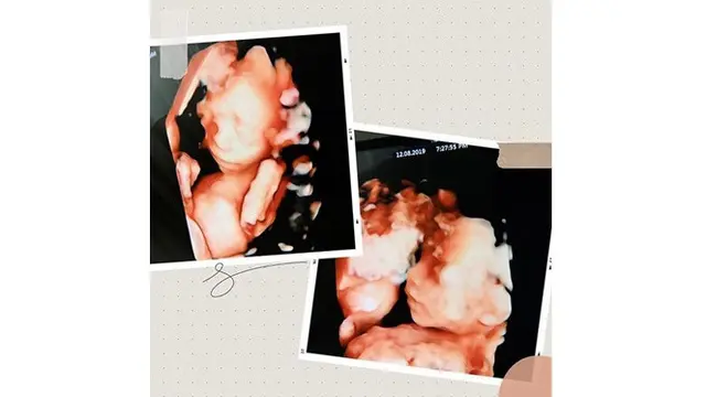 7 Potret Perjalanan Kehamilan Irish Bella Sebelum Bayi Kembarnya Meninggal