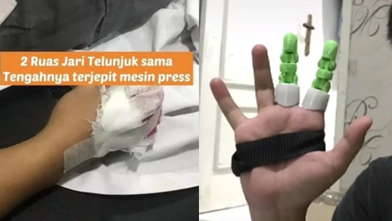 Pria Ini Buat Jari Palsu untuk Temannya yang Diamputasi, Bikin Salut Warganet
