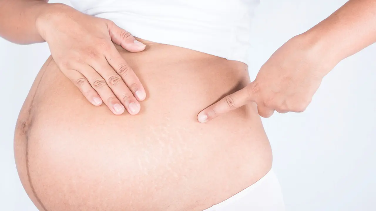 Ilustrasi strech mark pada ibu hamil