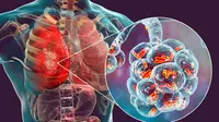 Legionnaires' Disease Outbreak Hits New York City: Dozens Ill, Three Dead