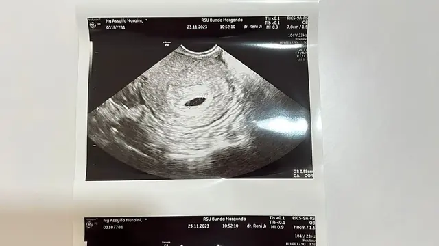 Setahun Melahirkan, Ini 6 Potret Syifa Adik Ayu Ting Ting Hamil Anak Kedua