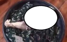 Viral Bayi dengan Kaki Menyatu di Sumatera Selatan, Begini Penjelasannya