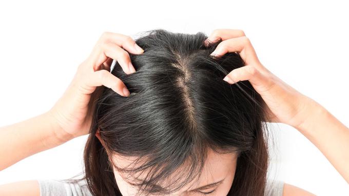 Cara Menghilangkan Kutu Rambut dan Telurnya dalam 1 Hari Tanpa Merusak