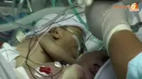 [VIDEO] Kondisi Kritis, Bayi Kembar Siam 5 Hari Harus Dipisah