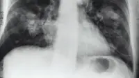 Dokter Ungkap Tantangan Penanganan Kanker Paru di Indonesia