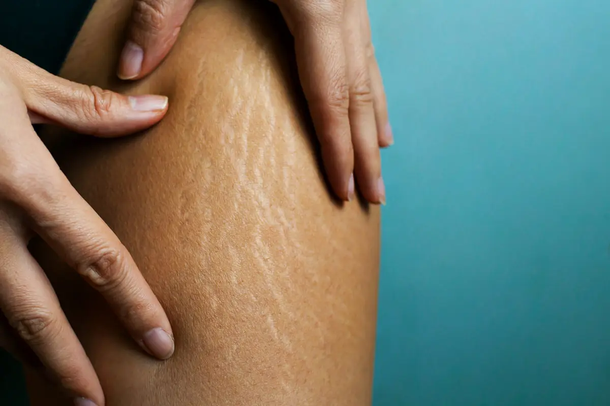 Stretch Mark