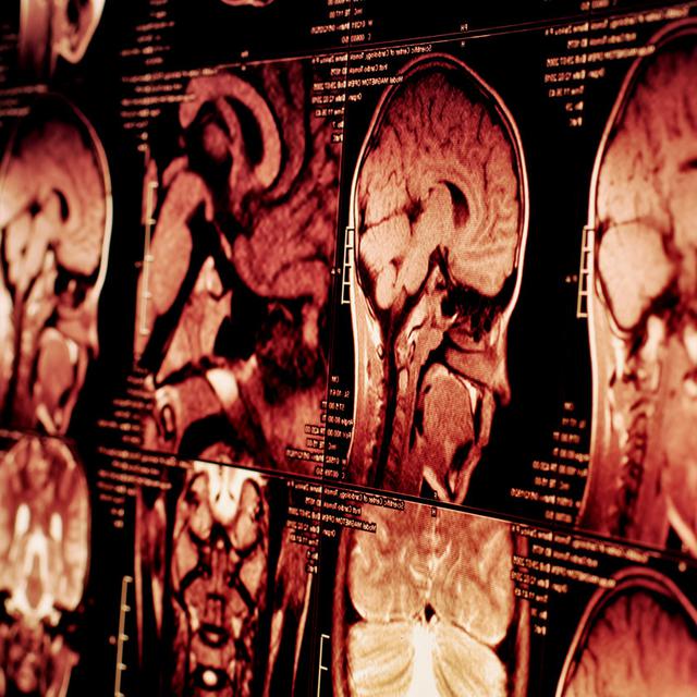 Gejala Kanker Otak Dan Penyebab Yang Wajib Diketahui Jangan
