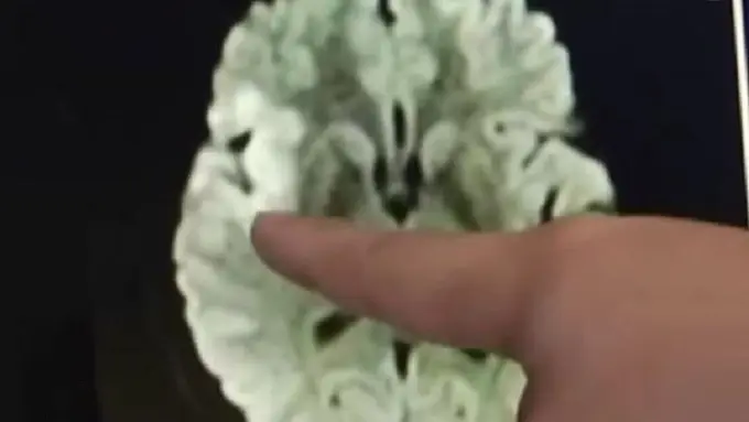 [Bintang] Pembekuan Otak