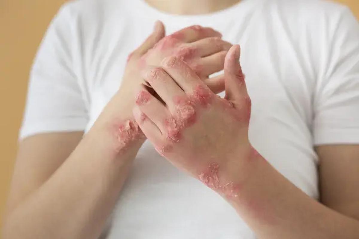 6 Gejala Kolesterol Tinggi yang Muncul dan Terlihat pada Kulit, Perhatikan Tandanya