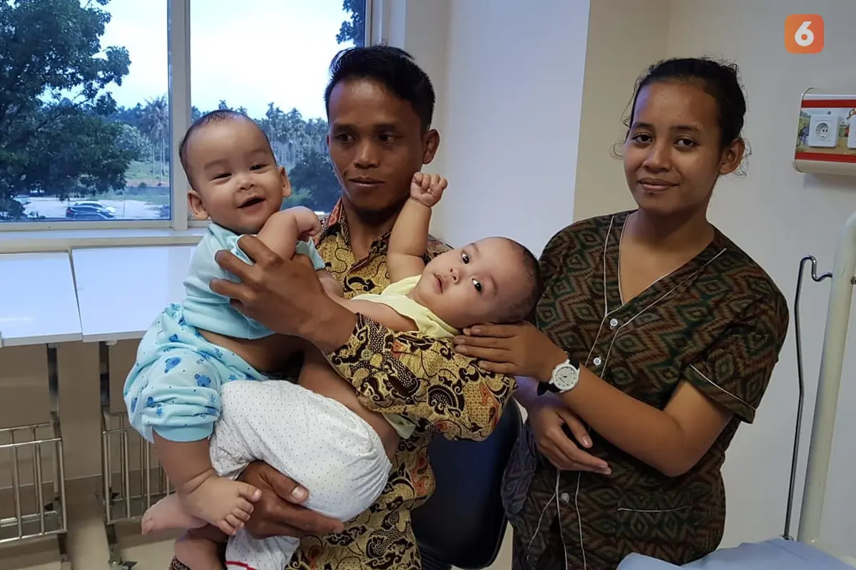 Bayi Kembar Siam