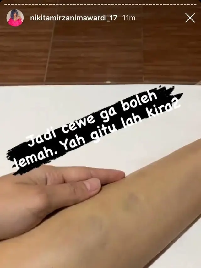 kaki Nikita Mirzani bengkak dan memar usai jatuh dari motor (Instagram Stories)