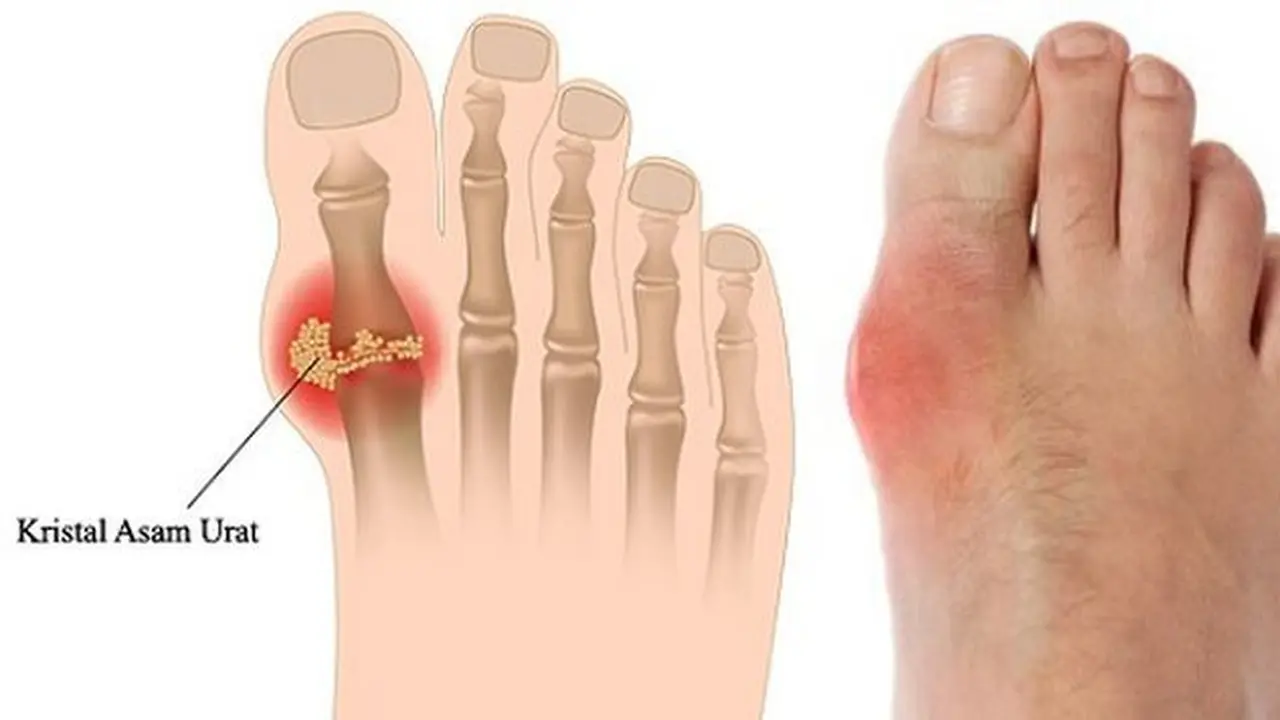 Pembengkakan jempol karena asam urat/alodokter.com