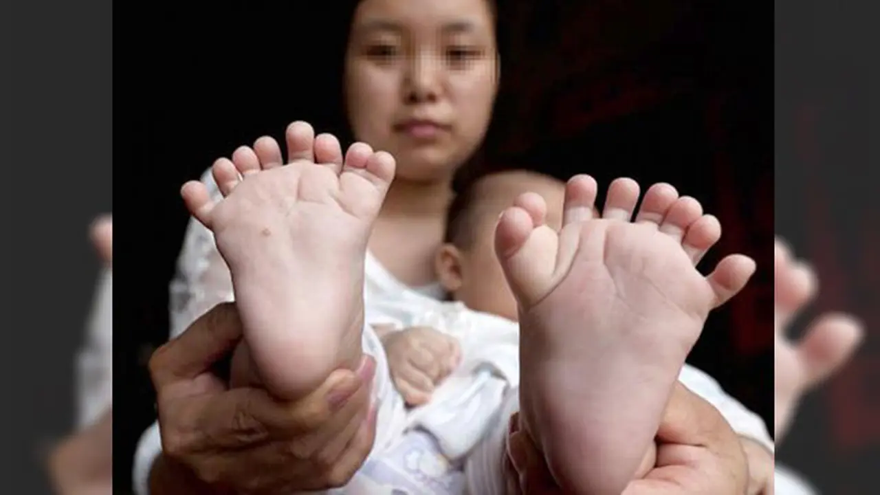 Bayi yang Lahir dengan 31 Jari Akhirnya Jalani Operasi