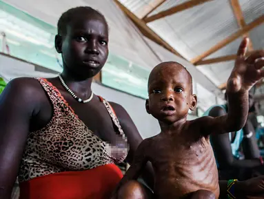 Seorang wanita memegang anaknya yang terkena penyakit gizi burutk di sebuah klinik di Lankien, Sudan Selatan, (8/4). Menurut MSF, Kekurangan gizi didaerah sudan selatan sudah mencapai batas kritis. (Albert Gonzalez Farran / cds / AFP)