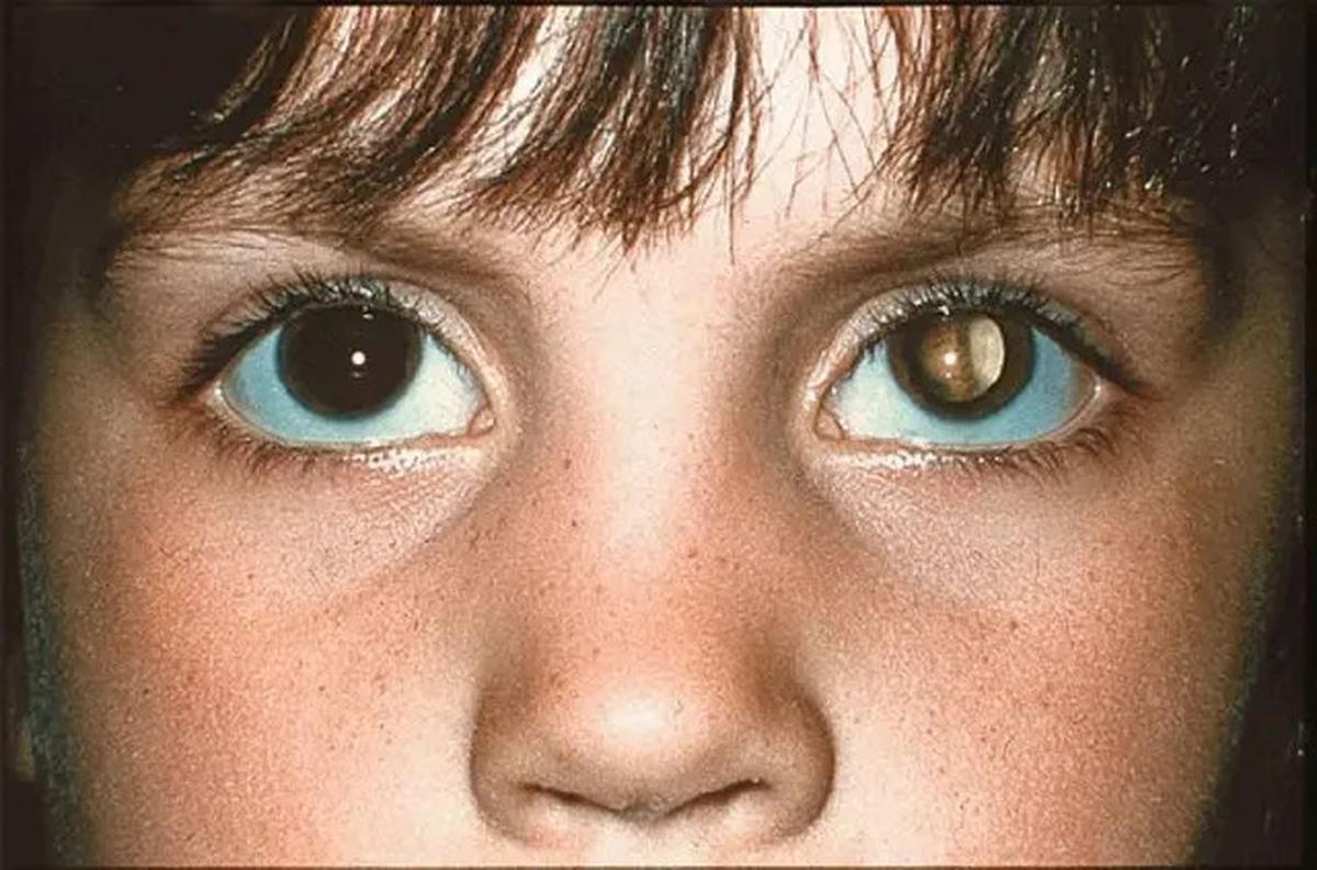 Tanda-Tanda Retinoblastoma pada Anak Sejak Dini