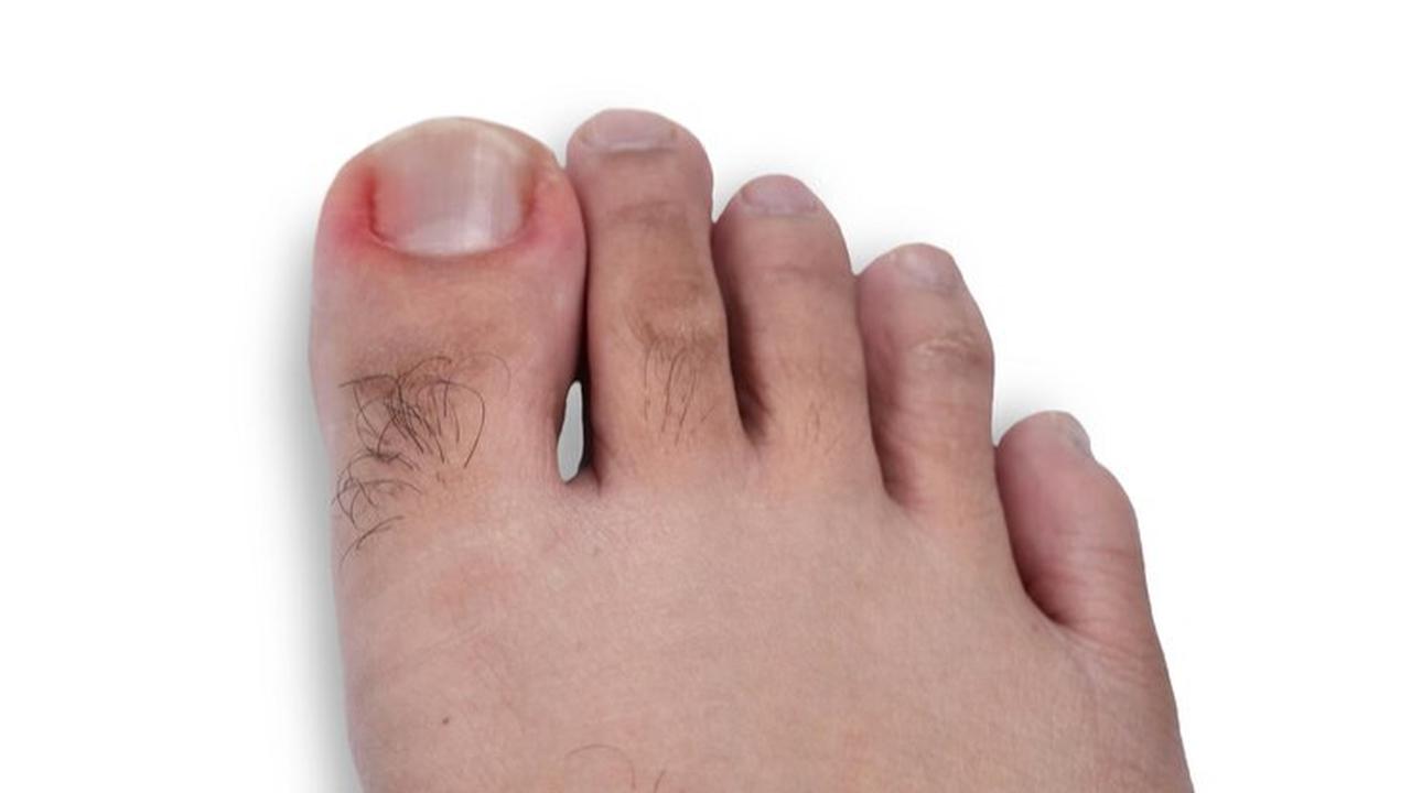 Penyebab Kuku Kaki Tumbuh ke Dalam