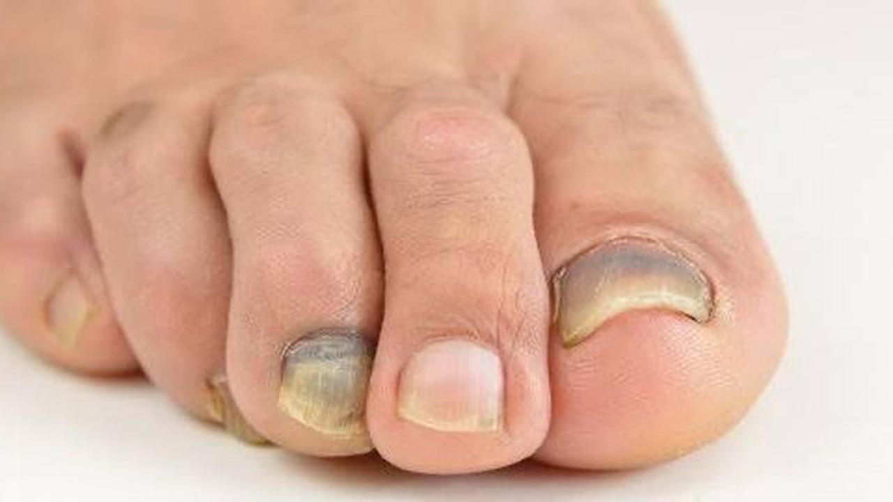 Cara Mengatasi Kuku Kuning karena Infeksi Jamur, Tidak Perlu dengan Kuteks