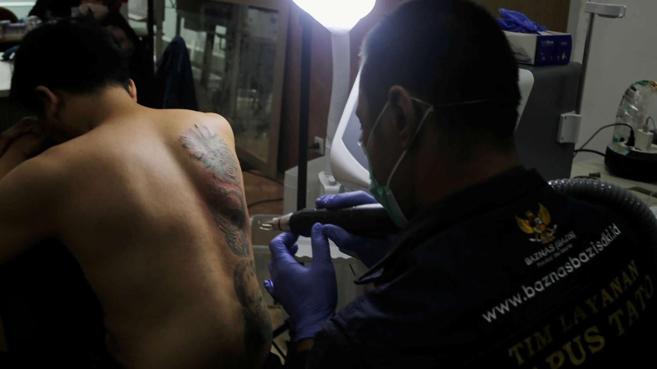 Layanan Hapus Tato Gratis di Jakarta