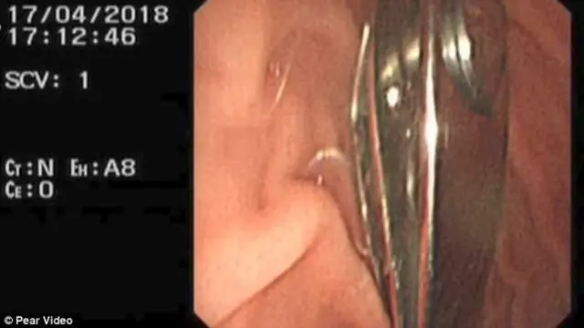 Bocah Tak Sengaja Telan Gunting Kuku, Ibu Panik Setengah Mati