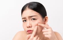 Punya Kulit Berjerawat? Ini Urutan Skincare Malam yang Paling Efektif untuk Hasil Maksimal dan Jerawat Langsung Kempes
