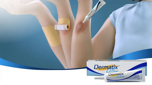 Cara hilangkan bekas koreng