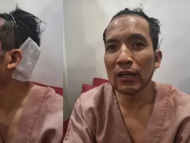 Desta Jalani Transplantasi Rambut (Foto: Instagram/ dr_tompi)