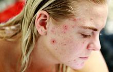 Bahaya Menggunakan Acne Patch Terlalu Lama, Bisa Sebabkan Iritasi